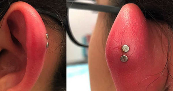 Cách chữa xỏ khuyên sụn tai bị sưng hiệu quả tại nhà