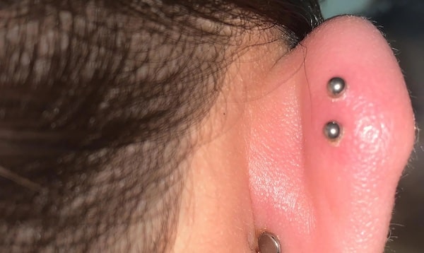 Cách chữa xỏ khuyên sụn tai bị sưng hiệu quả tại nhà