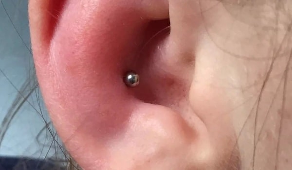 Cách chữa xỏ khuyên sụn tai bị sưng hiệu quả tại nhà