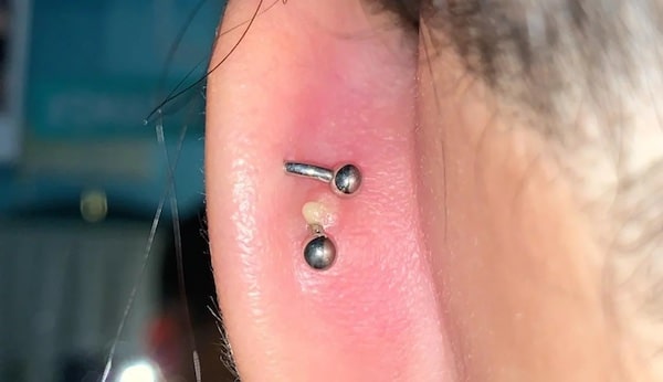 Cách chữa xỏ khuyên sụn tai bị sưng hiệu quả tại nhà