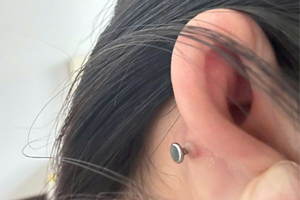 Cắt bump bao nhiêu tiền?