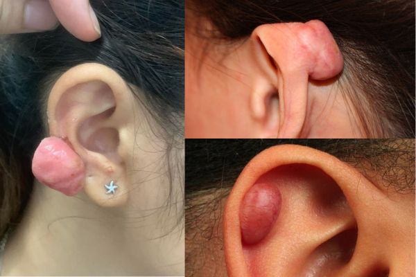 Cắt bump bao nhiêu tiền?