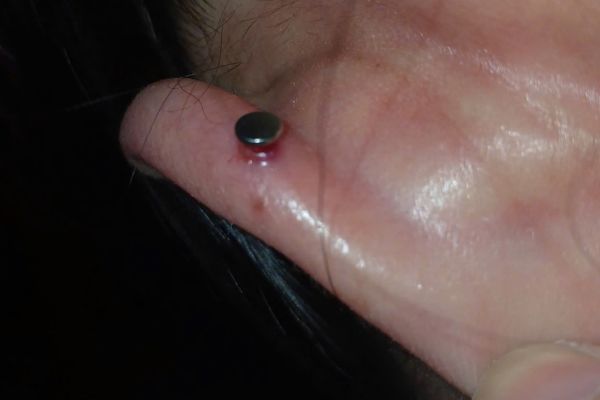 Cắt bump bao nhiêu tiền?