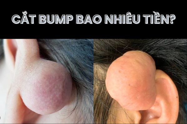 Cắt bump bao nhiêu tiền?