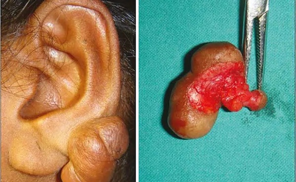 Cắt bump bao nhiêu tiền?