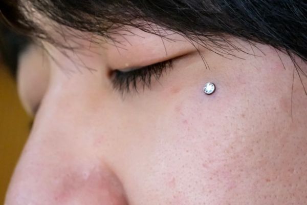 Cấy khuyên đuôi mắt (Gò má)