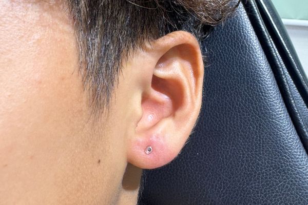 Cơ địa kích ứng xỏ khuyên thuỷ tinh được không?