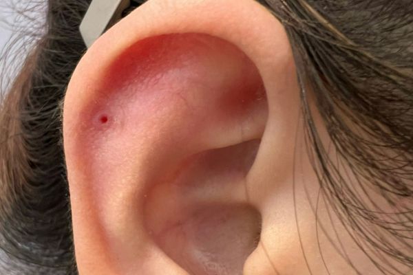 Có nên nặn bump tại nhà không?