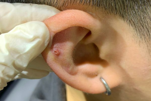 Có nên nặn bump tại nhà không?