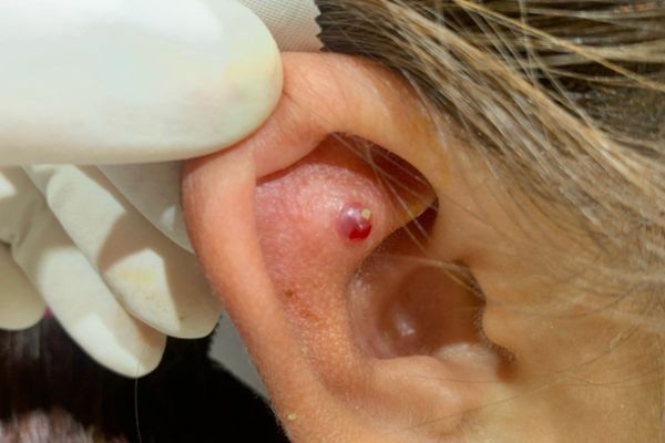 Có nên nặn bump tại nhà không?