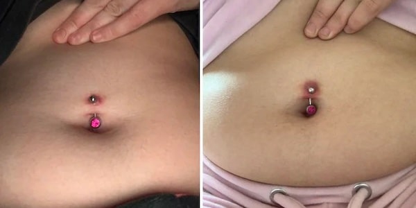 Dấu hiệu nhận biết lỗ xỏ khuyên bị đào thải