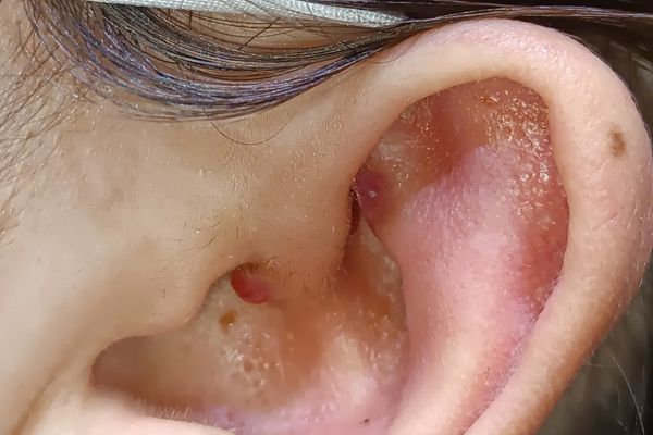 Giải pháp trị bump lỗ xỏ sau xỏ khuyên hiệu quả tại TinyBox