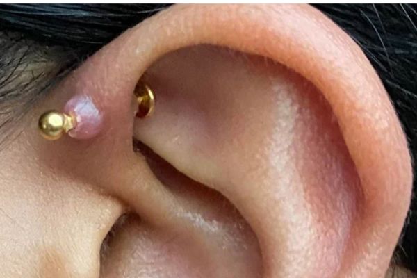 Giải pháp trị bump lỗ xỏ sau xỏ khuyên hiệu quả tại TinyBox