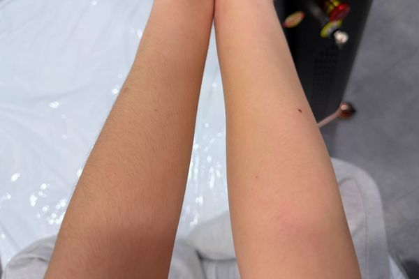 khách hàng triệt lông tại TinyBox an toàn, hiệu quả, không đau rát, sáng da