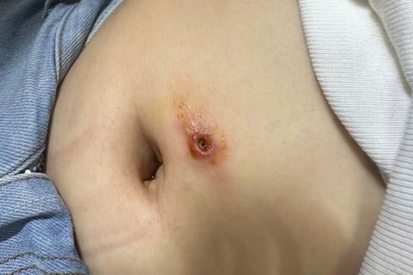 Khi nào thay khuyên rốn được?