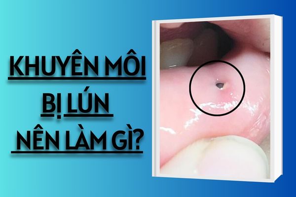 Khuyên môi bị lún phải làm sao?