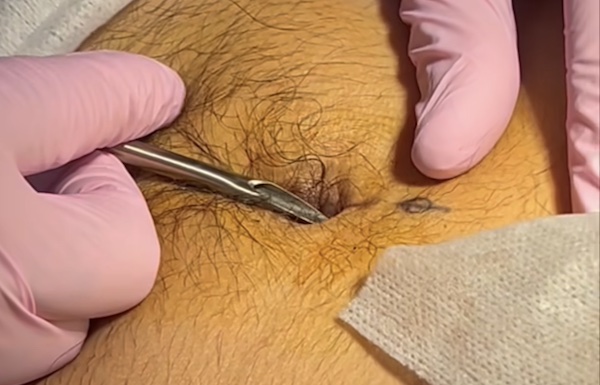 Phân biệt kiểu xỏ khuyên hiếm gặp và kiểu xỏ nguy hiểm