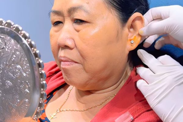 Lỗ bấm tai bị chảy xệ phải làm sao?