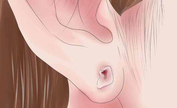 Lỗ khuyên tai bị chảy nước ngứa