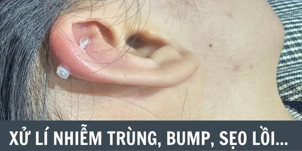 Lỗ khuyên tai bị chảy nước ngứa