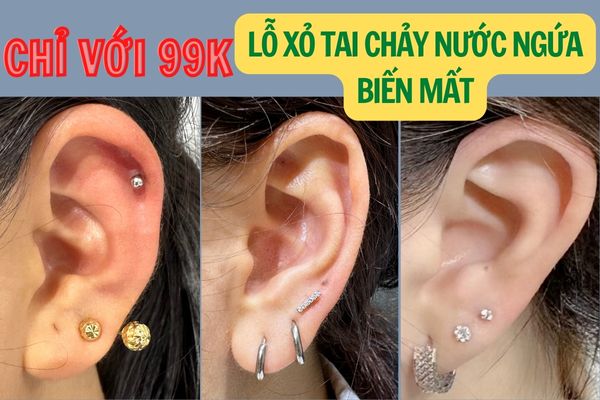 Lỗ khuyên tai bị chảy nước ngứa