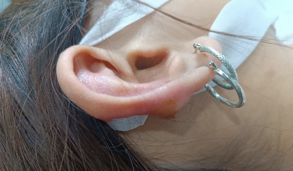 lỗ xỏ bị sưng