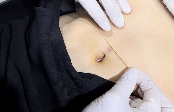 Lỗ xỏ khuyên bị bít có xỏ lại được không?