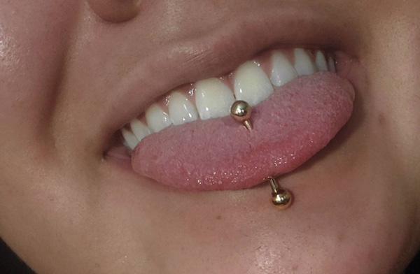 Lỗ xỏ khuyên bị bít có xỏ lại được không?