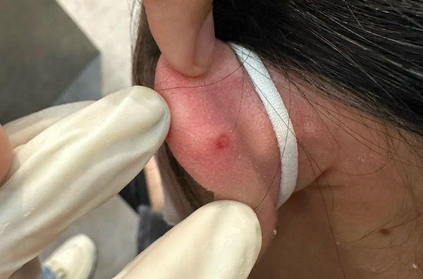 lỗ xỏ khuyên bị bump