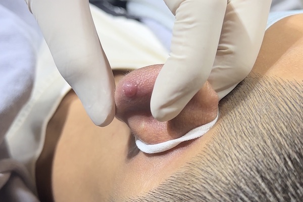 lỗ xỏ khuyên bị bump