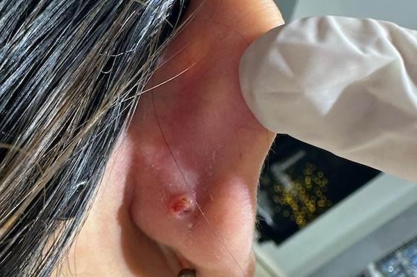 lỗ xỏ khuyên bị bump