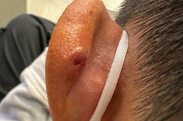 lỗ xỏ khuyên bị bump