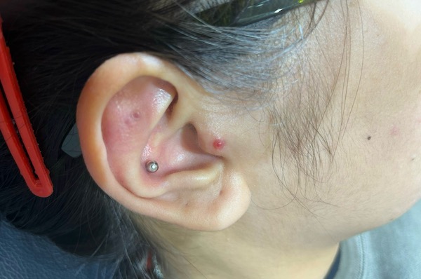 lỗ xỏ khuyên bị bump