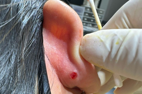 lỗ xỏ khuyên bị bump