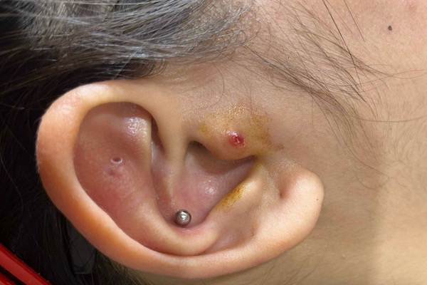 lỗ xỏ khuyên bị bump