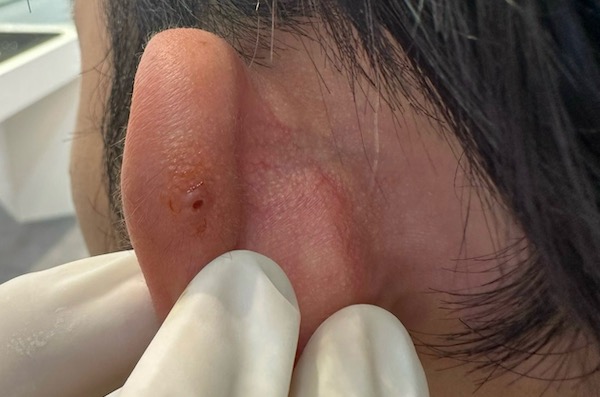 lỗ xỏ khuyên bị bump