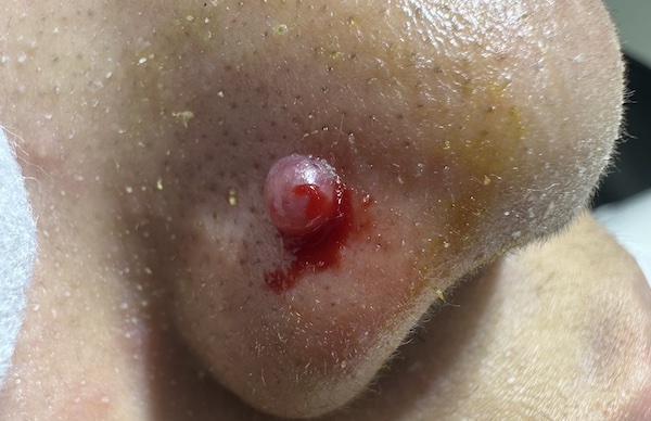 lỗ xỏ khuyên bị bump