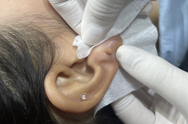 Lỗ xỏ khuyên bị chảy mủ