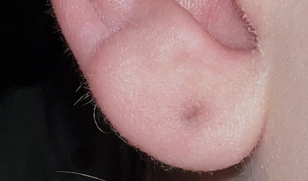 Lỗ xỏ khuyên bị đen