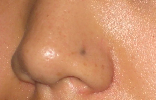 Lỗ xỏ khuyên bị đen