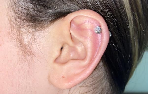 Lỗ xỏ khuyên bị lệch