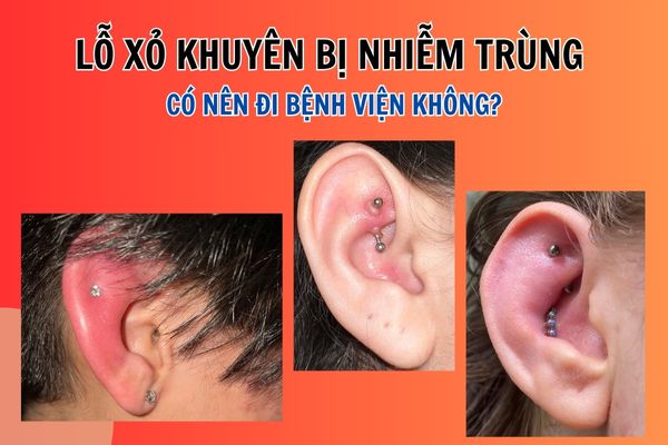 Lỗ xỏ khuyên bị nhiễm trùng có nên đi bệnh viện không?