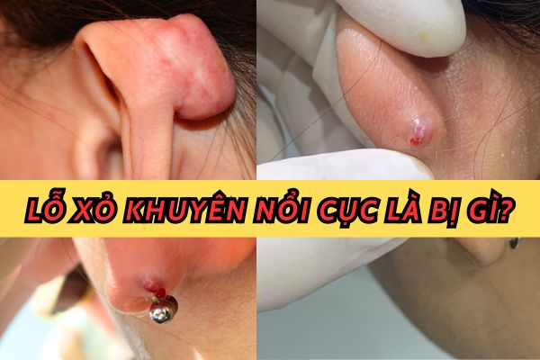 Lỗ xỏ khuyên bị nổi cục là bị gì?