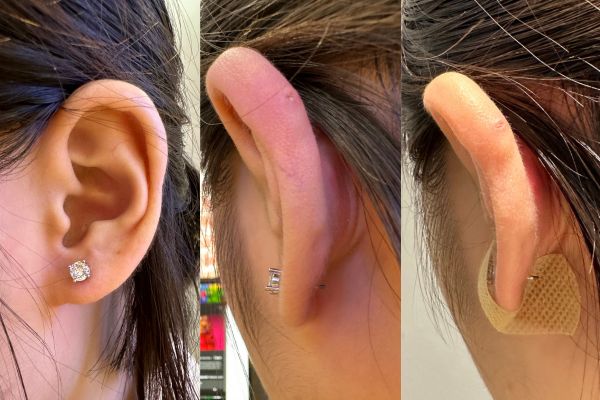 Lỗ xỏ khuyên bị rớt chốt làm sao để giữ lỗ tạm thời?