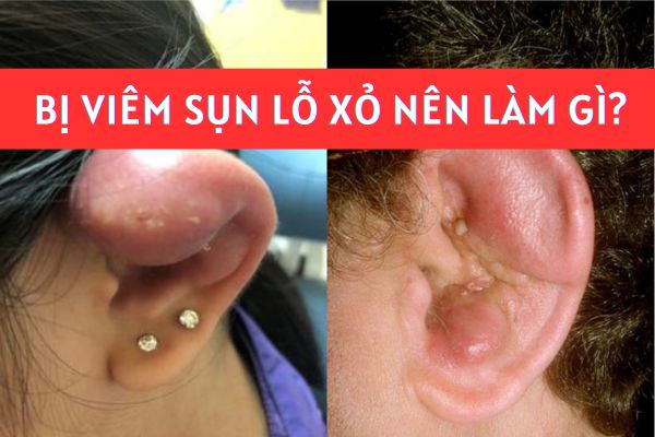 Lỗ xỏ khuyên bị viêm sụn nên làm gì