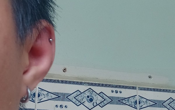 Lỗ xỏ khuyên bị viêm sụn nên làm gì