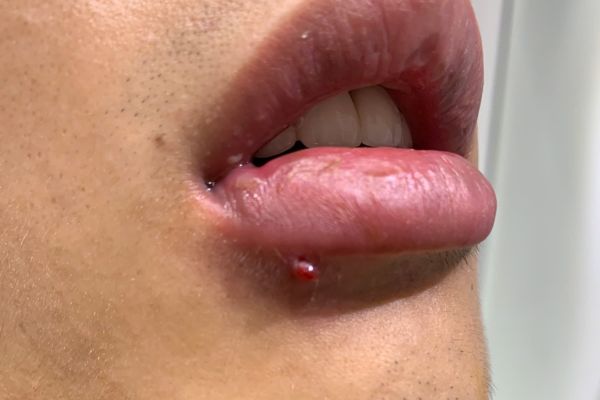 Lỗ xỏ khuyên môi bị lồi thịt