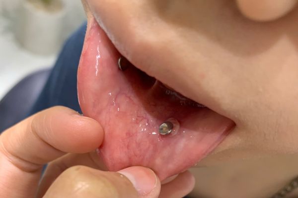 Lỗ xỏ khuyên môi bị lồi thịt