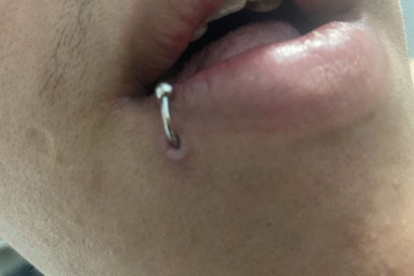 Lỗ xỏ khuyên môi bị lồi thịt