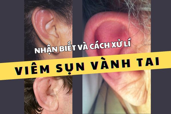 Nhận biết lỗ xỏ khuyên tai bị sưng viêm nặng và cách xử lí